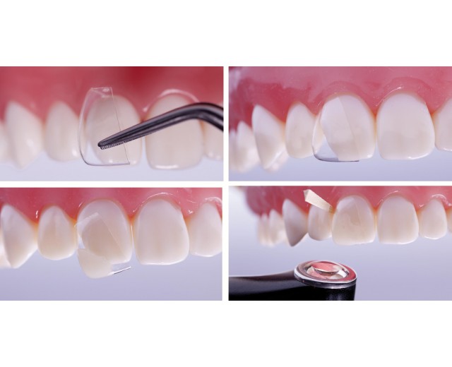 Matrices Coform Matrices Dentales Restauración Dental